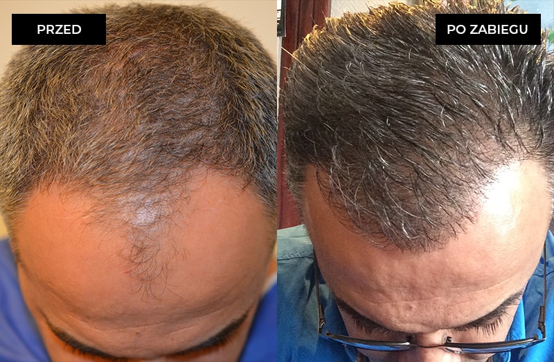 Przed i po przeszczepie włosów metodą FUE