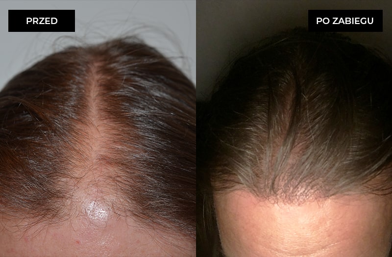 Zdjęcie przed I po zabiegu przeszczepu włosów FUE